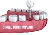 Dental Implants - Simply Dental Chatswood
