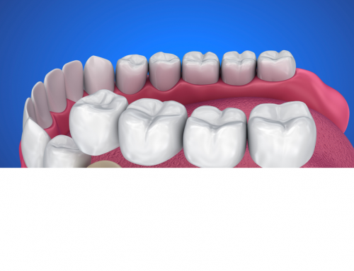 Dental Bridge: What Type is Best for Me?